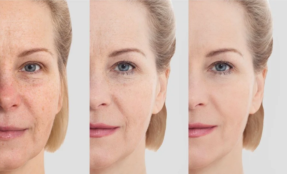 anti-wrinkle Injection in Knightsbridge, Anti-wrinkle treatment London