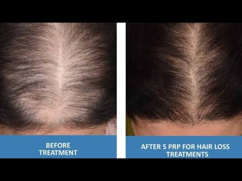 Best hair PRP Treatment before after 1