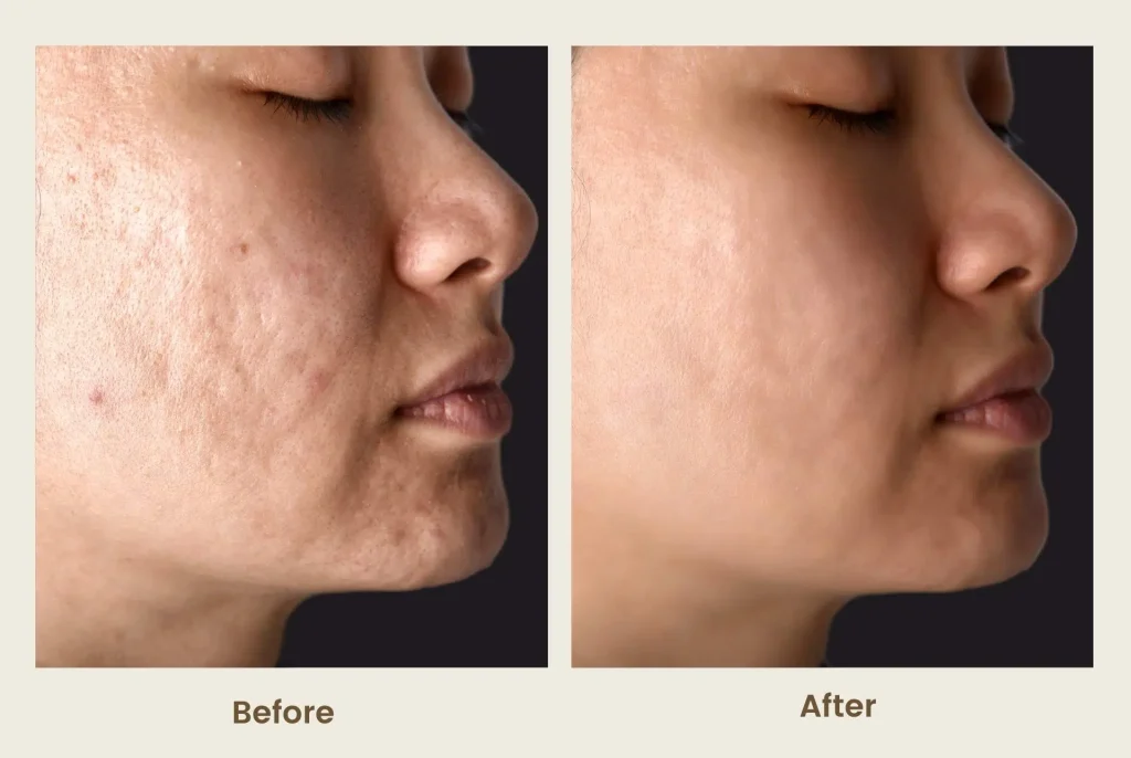 Following these steps will help your skin rejuvenation in Knightsbridge London results last longer.