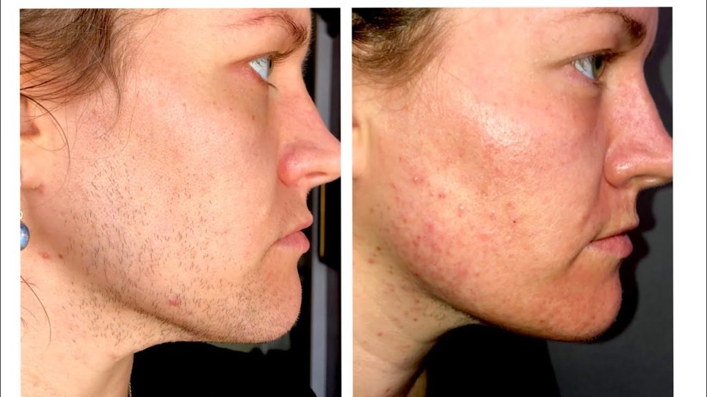 PCOS skin and hair treatment Knightsbridge before & after