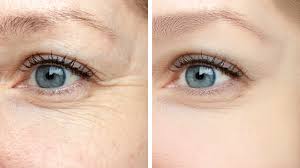 Fine Lines and Wrinkles Treatment in London