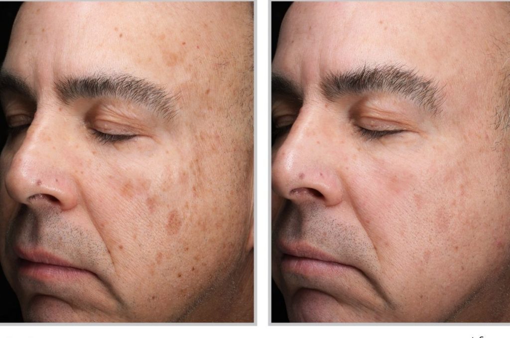 Laser Skin Resurfacing in London Smooth Renew Your Skin 1